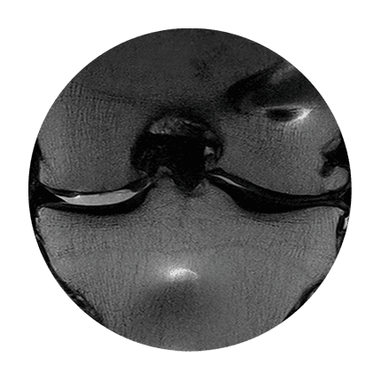 Post-procedure knee MRI view 1