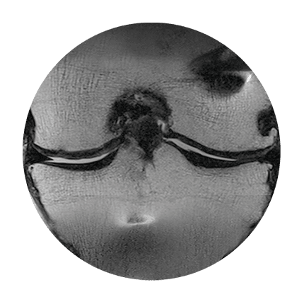 Post-procedure knee MRI view 2