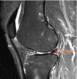 Coronal MRI before treatment